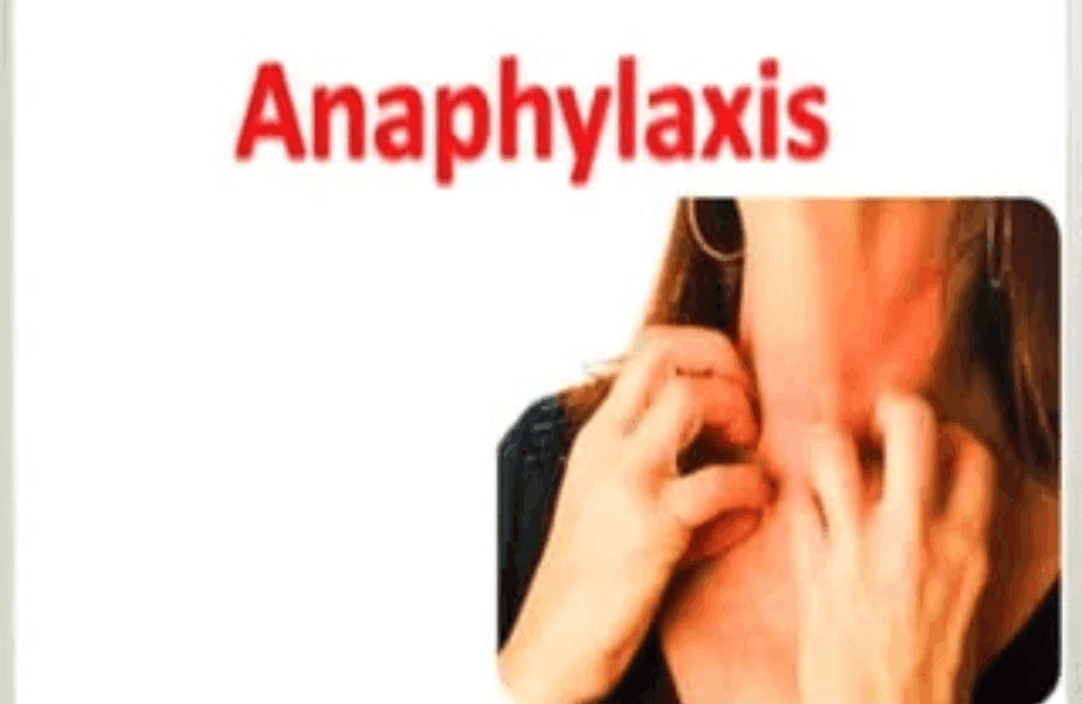 Anaphylaxis Symptoms and Causes