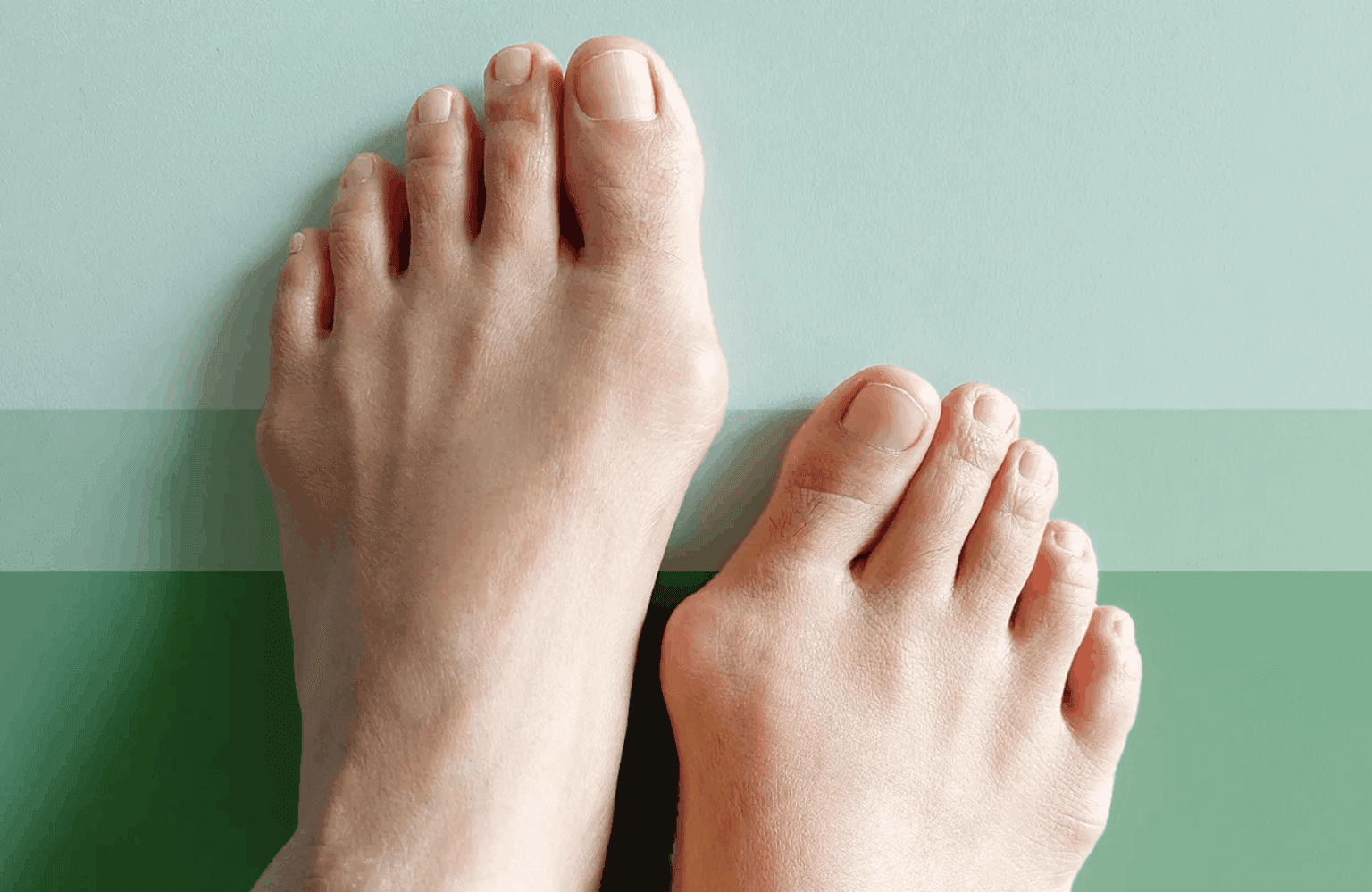 Bunions Causes and Symptoms